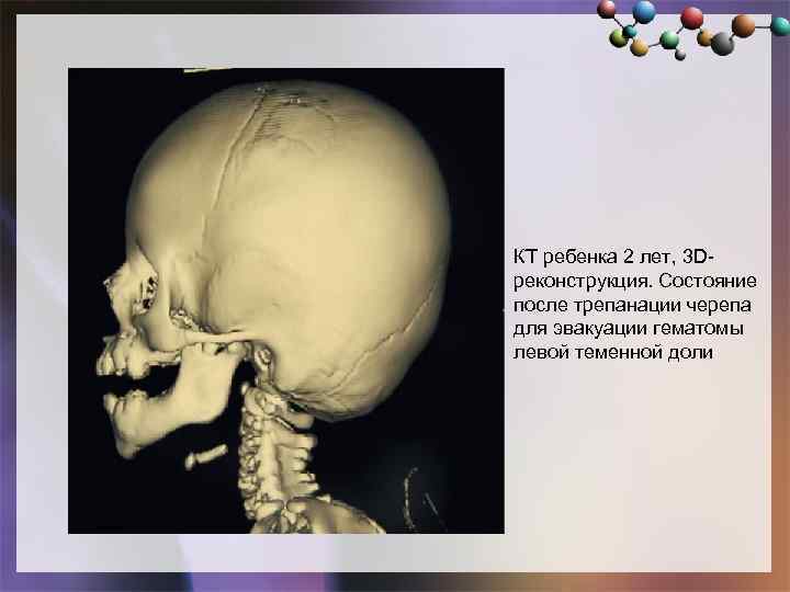 КТ ребенка 2 лет, 3 Dреконструкция. Состояние после трепанации черепа для эвакуации гематомы левой