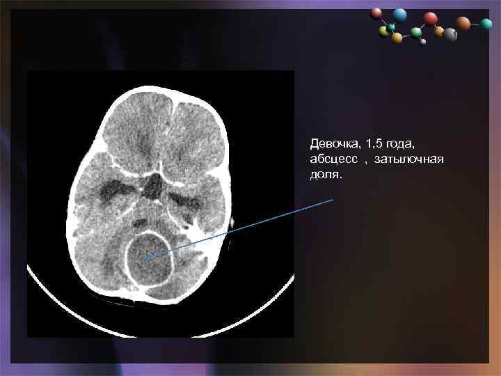  • Подзаголовок слайда Девочка, 1, 5 года, абсцесс , затылочная доля. 