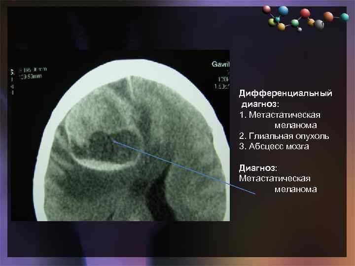  • Подзаголовок слайда Дифференциальный диагноз: 1. Метастатическая меланома 2. Глиальная опухоль 3. Абсцесс