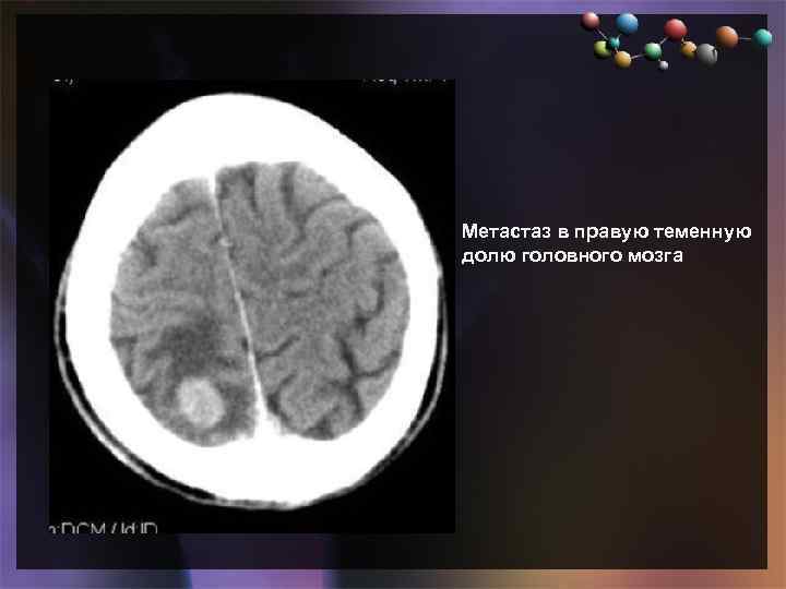  • Подзаголовок слайда Метастаз в правую теменную долю головного мозга 