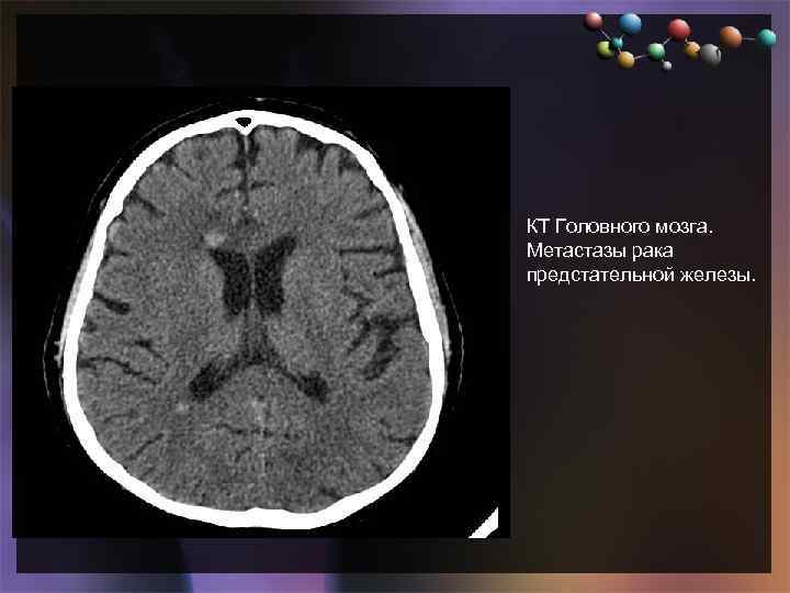  • Подзаголовок слайда КТ Головного мозга. Метастазы рака предстательной железы. 