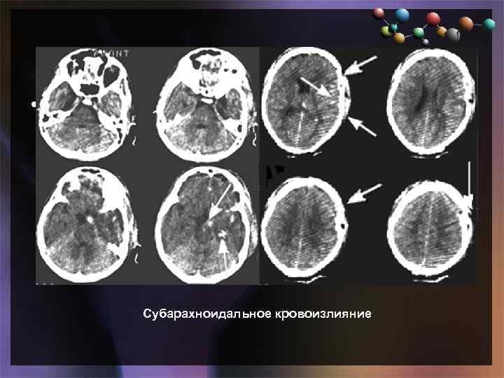  • Подзаголовок слайда Субарахноидальное кровоизлияние 
