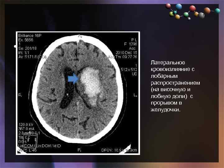  • Подзаголовок слайда Латеральное кровоизлияние с лобарным распространением (на височную и лобную доли)