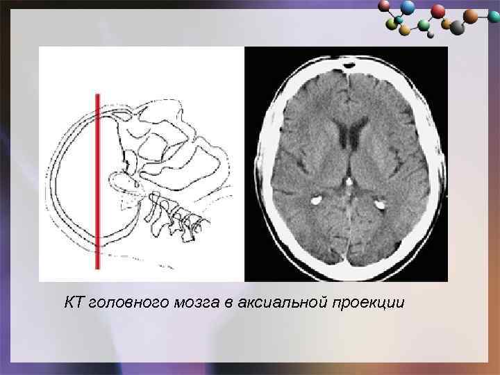 Аксиальная проекция. Кт головного мозга проекции. Аксиальная проекция кт.