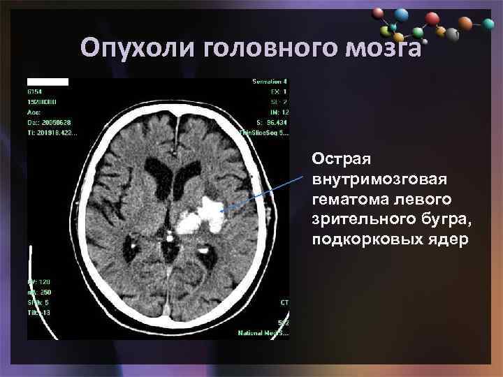 Диагноз опухоли мозга