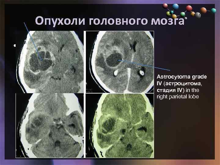 Образование головного мозга код по мкб 10. Кт диагностика опухолей головного мозга. Опухоль головного мозга астроцитома. Объемное образование головного мозга диагноз.