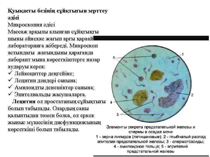 Қуықасты безінің сұйқтығын зерттеу әдісі Микроскопия әдісі Массаж арқылы алынған сұйқтықты шыны әйнекке жағып
