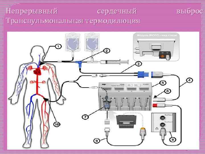 Непрерывный сердечный Транспульмональная термодилюция выброс 