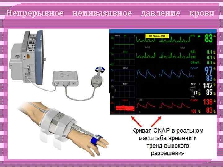 Непрерывное неинвазивное давление крови 