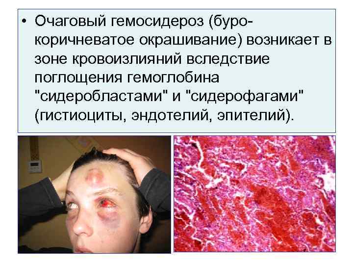  • Очаговый гемосидероз (бурокоричневатое окрашивание) возникает в зоне кровоизлияний вследствие поглощения гемоглобина "сидеробластами"