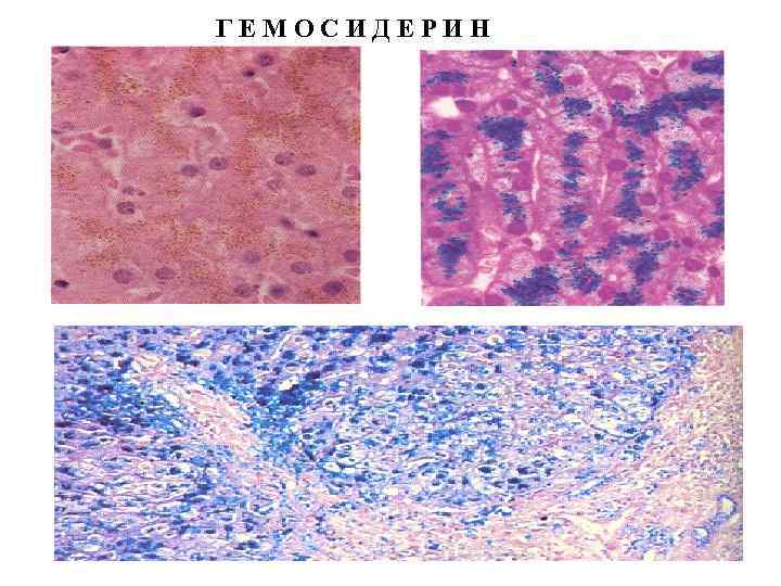 ГЕМОСИДЕРИН 