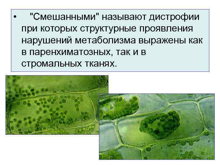  • "Cмешанными" называют дистрофии при которых структурные проявления нарушений метаболизма выражены как в