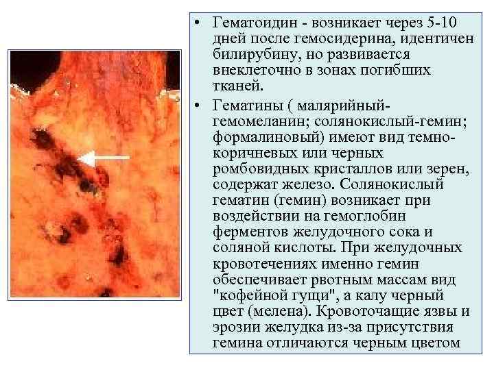  • Гематоидин - возникает через 5 -10 дней после гемосидерина, идентичен билирубину, но