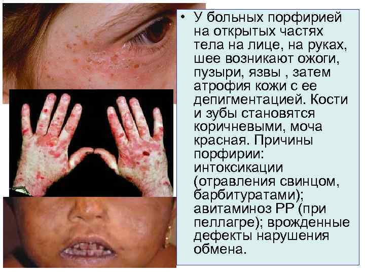  • У больных порфирией на открытых частях тела на лице, на руках, шее
