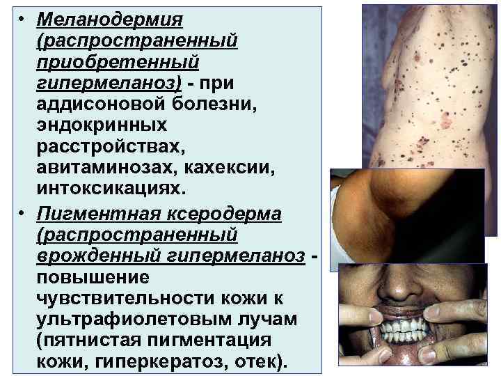  • Меланодермия (распространенный приобретенный гипермеланоз) - при аддисоновой болезни, эндокринных расстройствах, авитаминозах, кахексии,