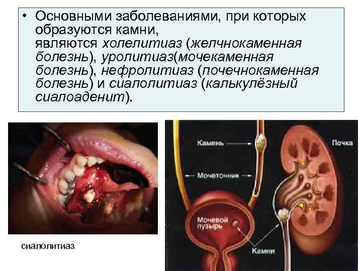  • Основными заболеваниями, при которых образуются камни, являются холелитиаз (желчнокаменная болезнь), уролитиаз(мочекаменная болезнь),