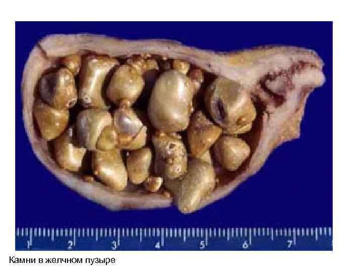 Камни в желчном пузыре 