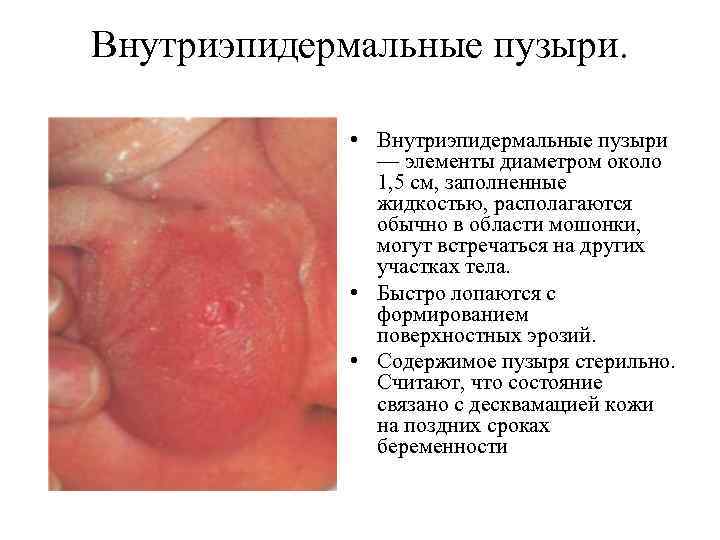 Внутриэпидермальные пузыри. • Внутриэпидермальные пузыри — элементы диаметром около 1, 5 см, заполненные жидкостью,