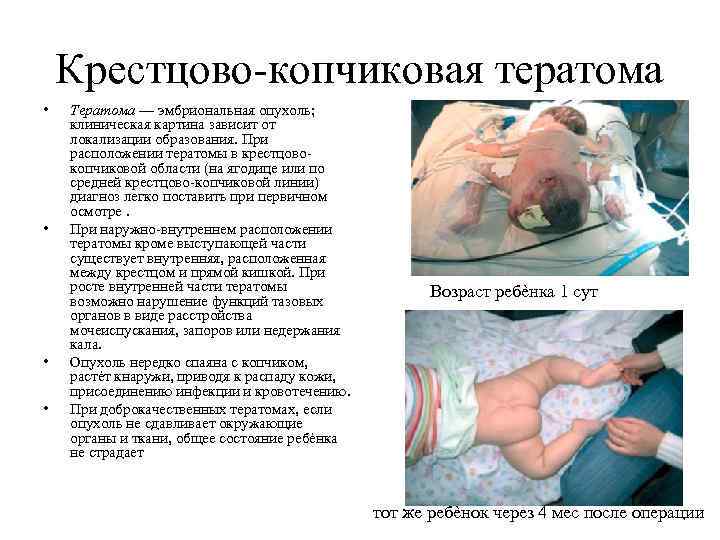 Крестцово-копчиковая тератома • • Тератома — эмбриональная опухоль; клиническая картина зависит от локализации образования.