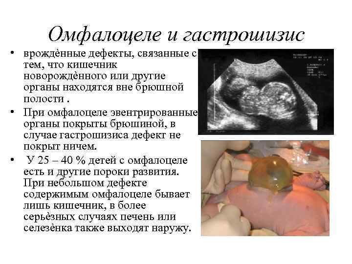 Омфалоцеле и гастрошизис • врождѐнные дефекты, связанные с тем, что кишечник новорождѐнного или другие