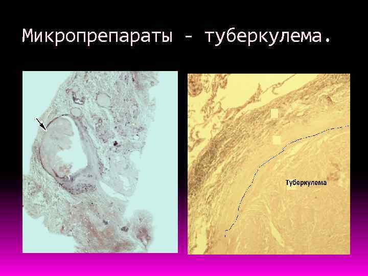 Микропрепараты - туберкулема. 