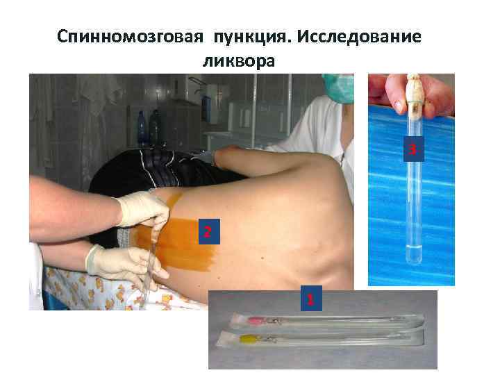 Спинномозговая пункция. Исследование ликвора 3 2 1 