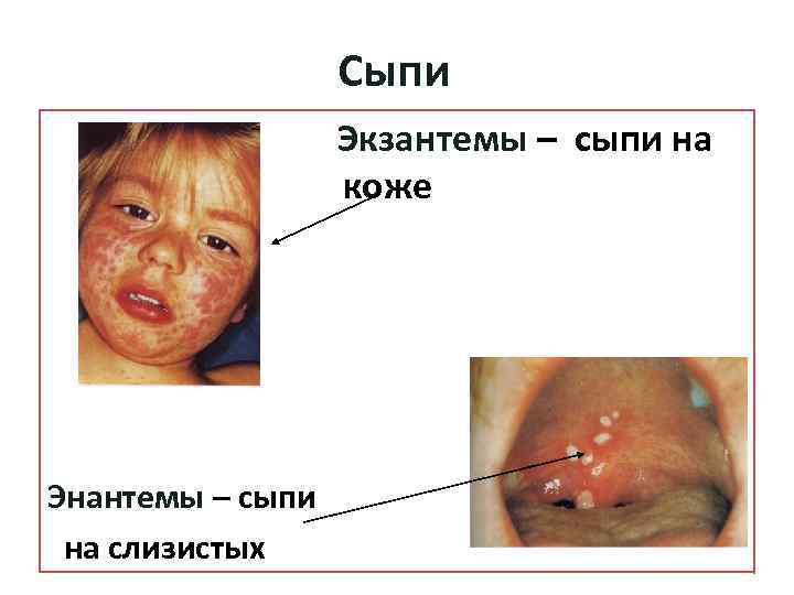 Сыпи Экзантемы ко Энантемы – сыпи на слизистых коже – сыпи на 