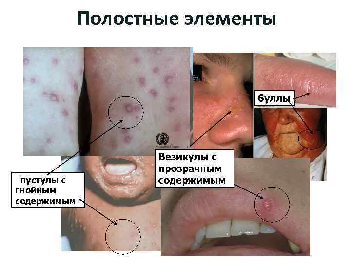 Полостные элементы буллы пустулы с гнойным содержимым Везикулы с прозрачным содержимым 