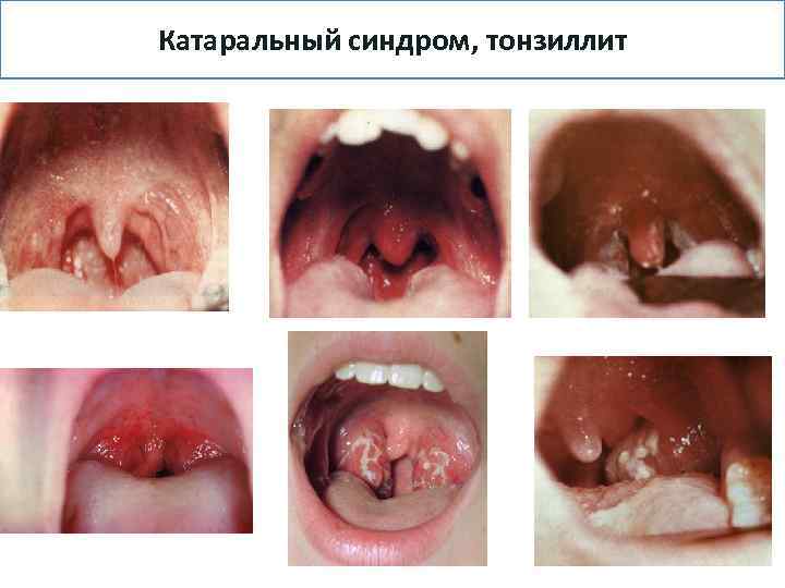 Катаральный синдром, тонзиллит 