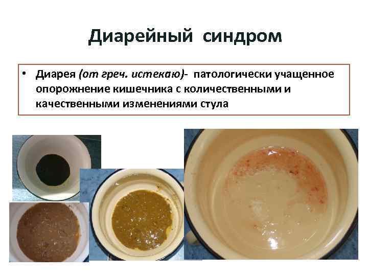 Диарейный синдром • Диарея (от греч. истекаю)- патологически учащенное опорожнение кишечника с количественными и