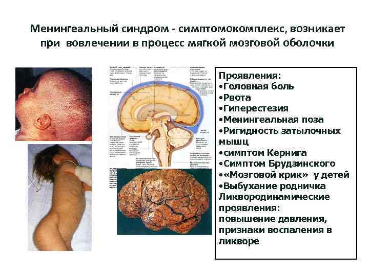 Менингеальный синдром - симптомокомплекс, возникает при вовлечении в процесс мягкой мозговой оболочки Проявления: •