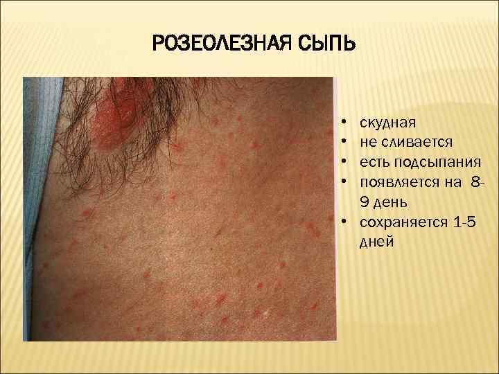 РОЗЕОЛЕЗНАЯ СЫПЬ • • скудная не сливается есть подсыпания появляется на 89 день •