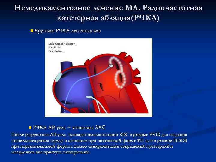 Немедикаментозное лечение МА. Радиочастотная катетерная аблация(РЧКА) n n Круговая РЧКА легочных вен РЧКА АВ-узла