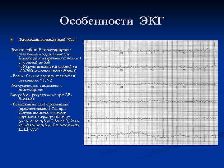 Особенности ЭКГ n Фибрилляция предсердий (ФП): -Вместо зубцов Р регистрируются различные по длительности, амплитуде