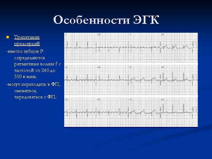 Особенности ЭГК Трепетание предсердий -вместо зубцов Р определяются ритмичные волны f с частотой от