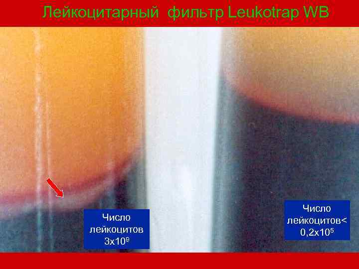 Лейкоцитарный фильтр Leukotrap WB Число лейкоцитов 3 х109 Число лейкоцитов< 0, 2 х105 