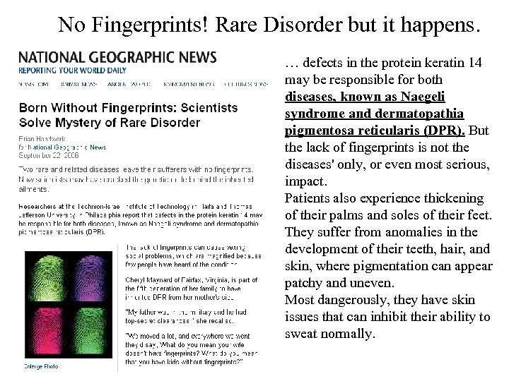 No Fingerprints! Rare Disorder but it happens. … defects in the protein keratin 14