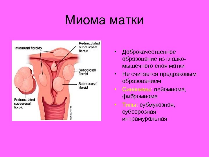 Миома матки • Доброкачественное образование из гладкомышечного слоя матки • Не считается предраковым образованием