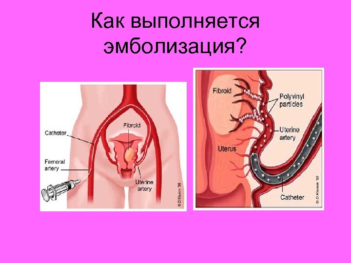 Как выполняется эмболизация? 