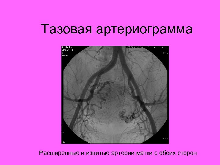 Тазовая артериограмма Расширенные и извитые артерии матки с обеих сторон 