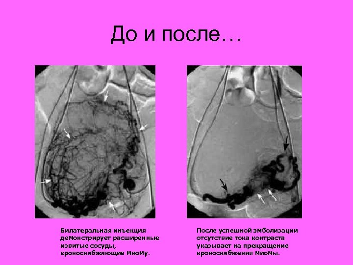 До и после… Билатеральная инъекция демонстрирует расширенные извитые сосуды, кровоснабжающие миому. После успешной эмболизации