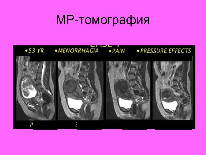 МР-томография 53 года До Меноррагия 3 мес Боль 6 мес Давление Через 1 год