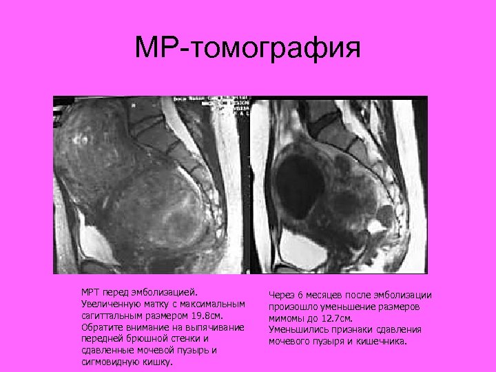 Увеличена матка. Передняя стенка матки мрт. Миома давит на мочевой пузырь.