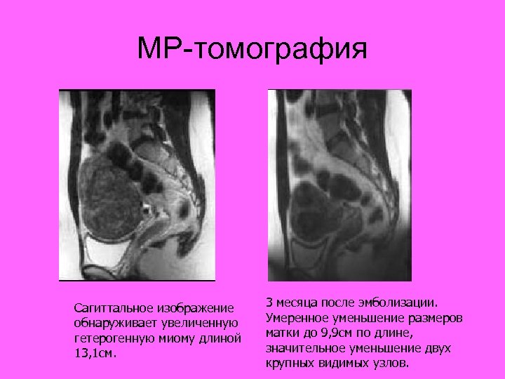 Миома матки мрт картина