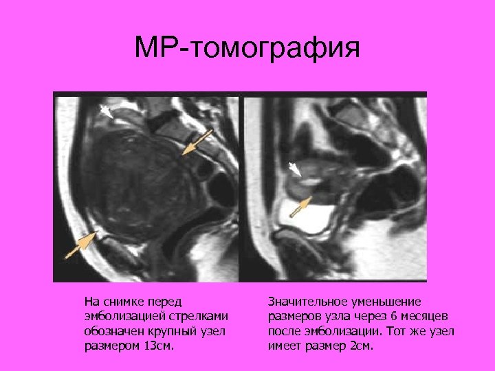 МР-томография На снимке перед эмболизацией стрелками обозначен крупный узел размером 13 см. Значительное уменьшение