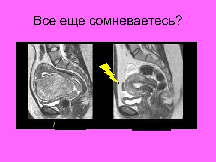 Все еще сомневаетесь? До ЭМА Через 6 мес 