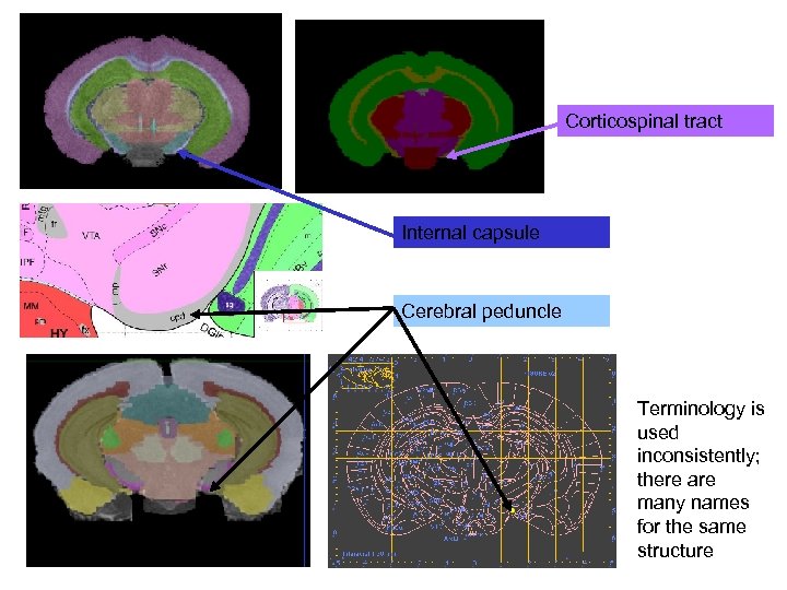 Corticospinal tract Internal capsule Cerebral peduncle Terminology is used inconsistently; there are many names