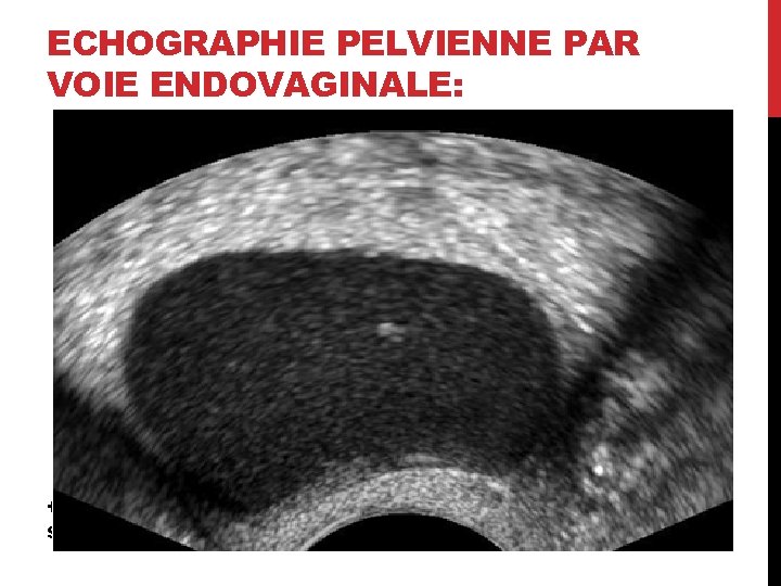 ECHOGRAPHIE PELVIENNE PAR VOIE ENDOVAGINALE: Examen de 1ère intention: • Signes directs: • Kyste