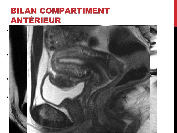 BILAN COMPARTIMENT ANTÉRIEUR • Vessie / uretères. • • Associées à d’autres lésions pelviennes