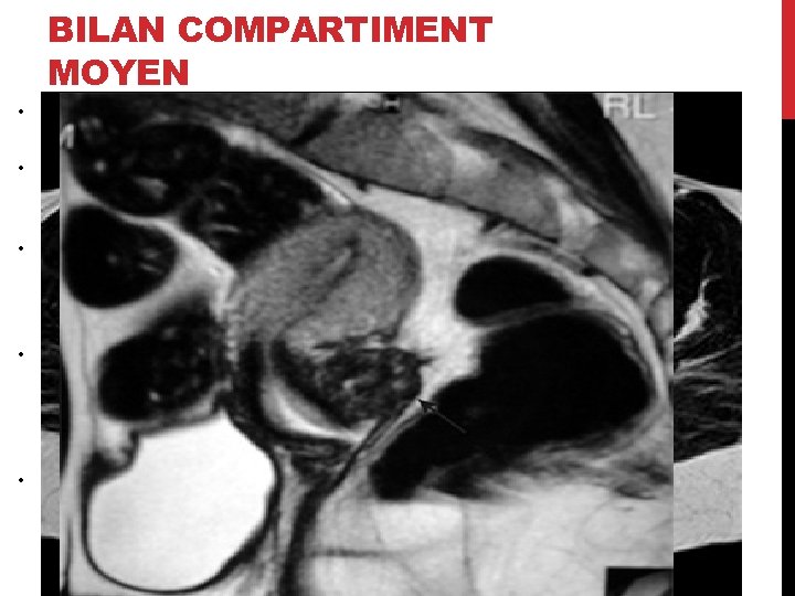 BILAN COMPARTIMENT MOYEN • Concerne l’utérus, les annexes, les ligaments ronds, larges et le